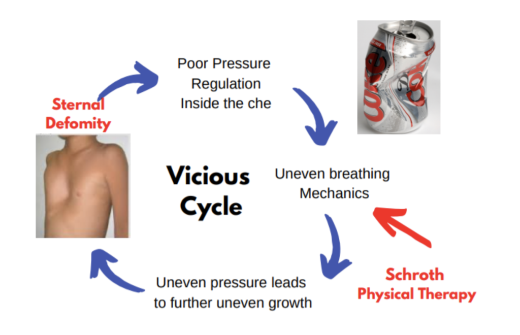 Pectus Excavatum: What it is & How to Treat it | Scoliosis PT Jax